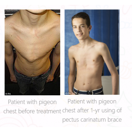 Carinatum Pectus Carinatum (Pigeon Chest) Brace