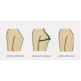 Carinatum Pectus Carinatum (Pigeon Chest) Brace