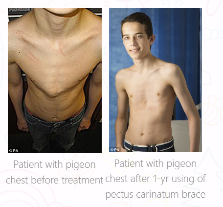 Carinatum Pectus Carinatum (Pigeon Chest) Brace - Back, Chest & Torso Supports - Orthopaedic Supports - Fu Kang Healthcare Shop Online Carinatum Pectus Carinatum (Pigeon Chest) Brace - Back, Chest & Torso Supports - Orthopaedic Supports - Fu Kang Healthcare Shop Online