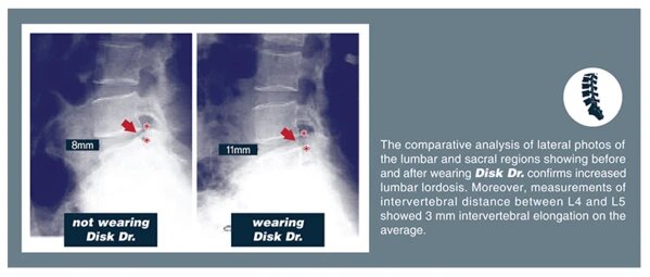 DiskDr Back Traction Belt From Korea X-ray before and after